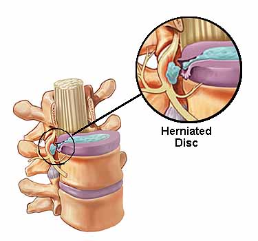 Can Chiropractic Help a Herniated Disc