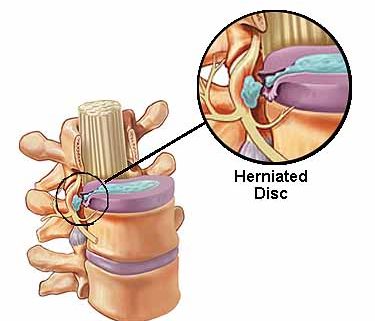 Can Chiropractic Help a Herniated Disc